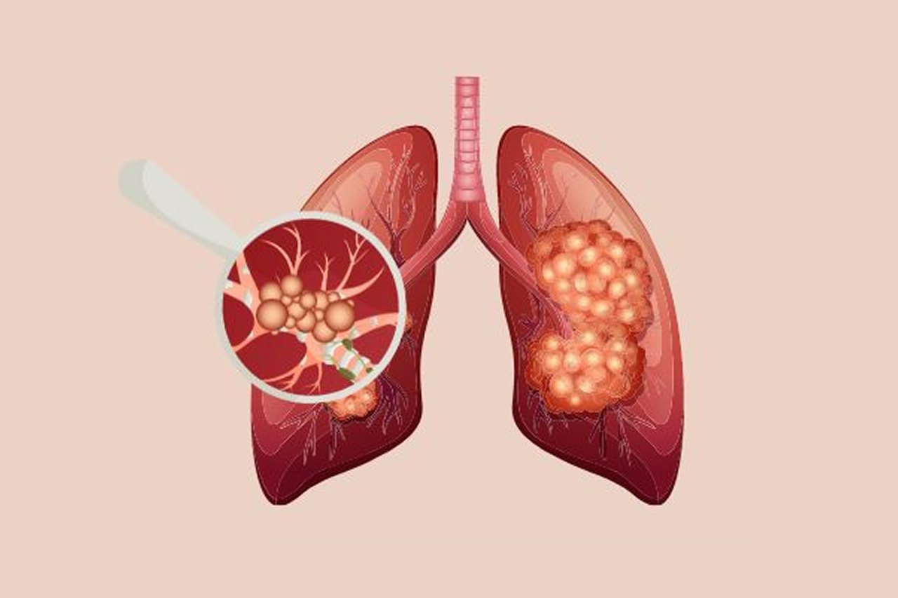 Interstitial Lung Disease (ILD)