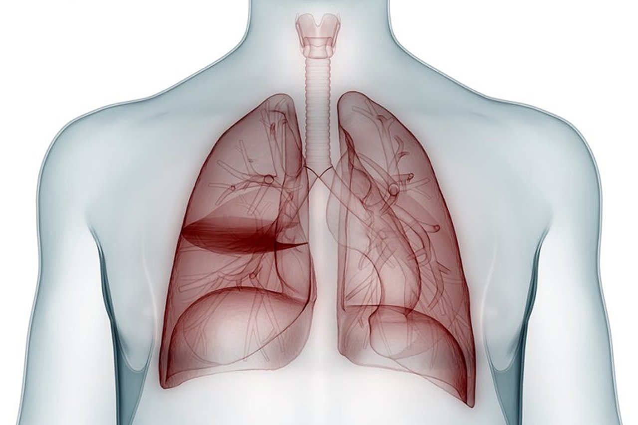 Complex Lung Disease